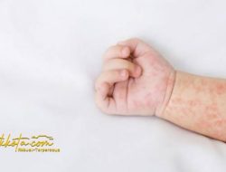 Kasus Campak di Pamekasan Tembus 305, Dua Anak Meninggal Dunia